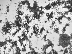 F,8y. | varicella pneumonia